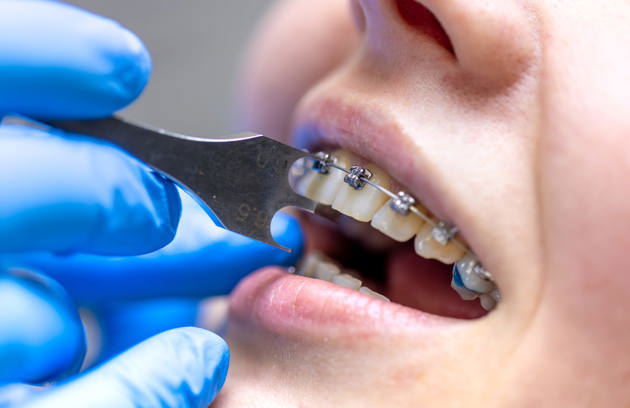 A dentist in Sharjah adjusting dental braces during a routine orthodontic appointment.